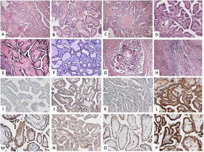 Neoadjuvant Multikinase Inhibitor in Patients With Locally Advanced Unresectable Thyroid Carcinoma